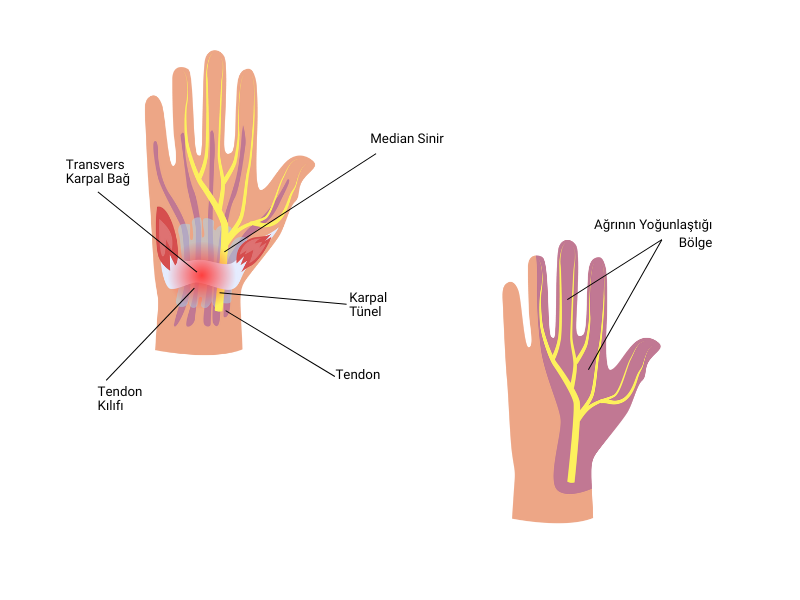 Karpal Tünel Sendromu